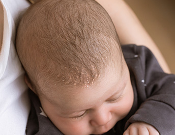 mustela baby cradle cap cream