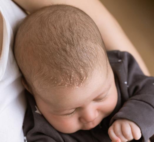 ▷¿Cómo se trata la costra láctea de los bebés?