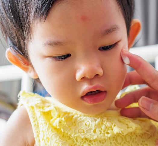 Eczéma bébé crème Mustela Stelatopia pour peau atopique