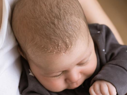 Find out more about cradle cap